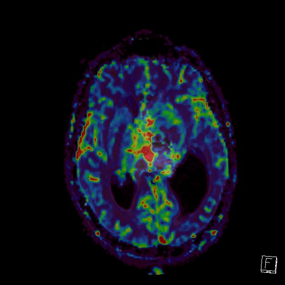 Central neurocytoma (Radiopaedia 84497-99872 Axial Perfusion 160).jpg