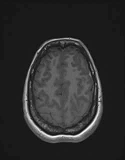 Central neurocytoma (Radiopaedia 84497-99872 Axial T1 158).jpg