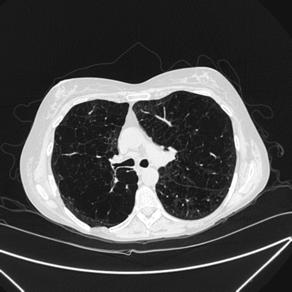 Centrilobular pulmonary emphysema (Radiopaedia 24495-24789 Axial lung window 39).jpg