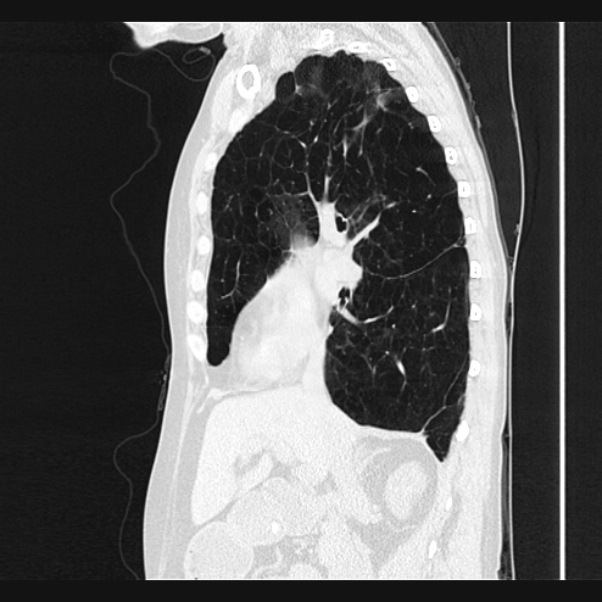 Centrilobular pulmonary emphysema (Radiopaedia 24495-24789 Sagittal lung window 33).jpg