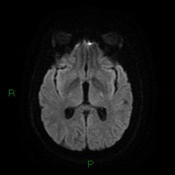 Cerebellar abscess (Radiopaedia 78135-90678 Axial DWI 16).jpg