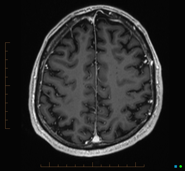 Cerebellar gangliocytoma (Radiopaedia 65377-74422 Axial T1 C+ 106).jpg