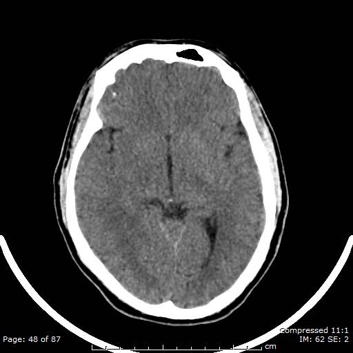 Cerebellar hemangioblastoma (Radiopaedia 52360-58258 Axial non-contrast 48).jpg