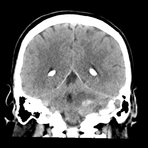 File:Cerebellar hemorrhage (Radiopaedia 37000-38669 Coronal non-contrast 32).png