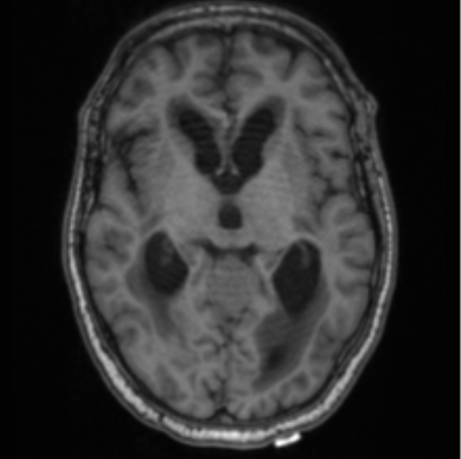 Cerebellar metastasis from lung adenocarcinoma (Radiopaedia 86690-102829 Axial T1 40).png