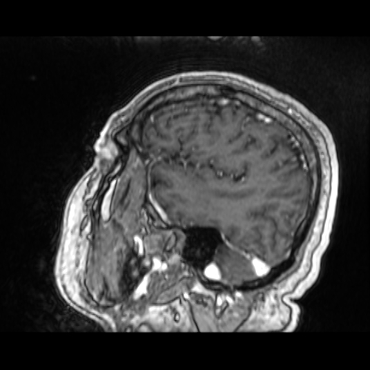 Cerebellar metastasis of pulmonary adenocarcinoma, cavernous venous malformation, and developmental venous anomaly (Radiopaedia 85827-101661 Sagittal T1 C+ 25).jpg