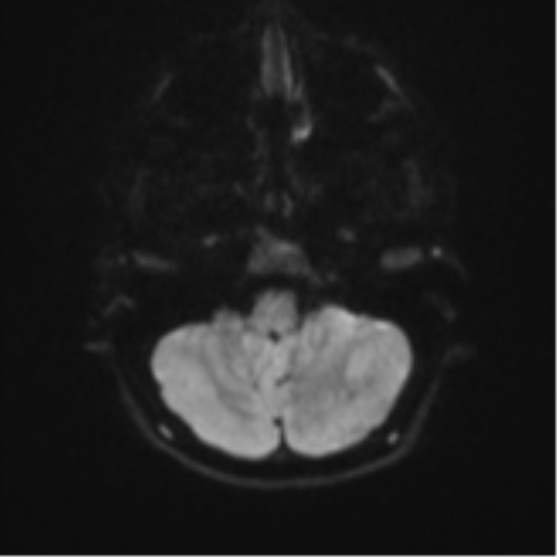 Cerebellar tuberculomas (Radiopaedia 46939-51472 Axial DWI 34).png