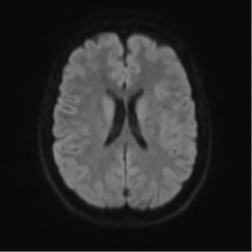 Cerebellar tuberculomas (Radiopaedia 46939-51472 Axial DWI 46).png