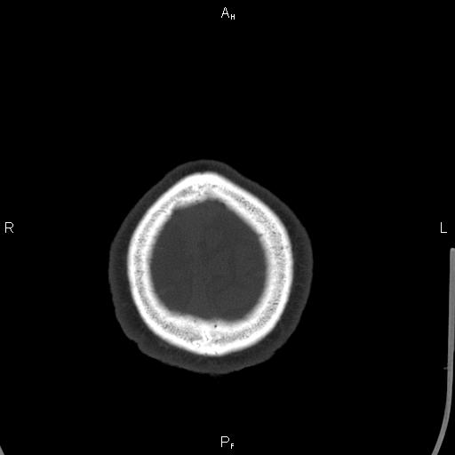 Cerebellopontine angle arachnoid cyst (Radiopaedia 85149-100704 Axial bone window 51).jpg