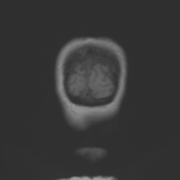 File:Cerebellopontine angle meningioma (Radiopaedia 53561-59591 Coronal T1 23).jpg