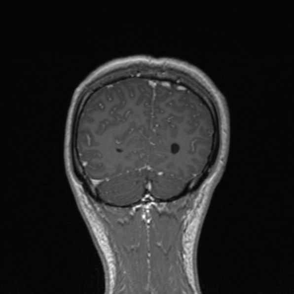Cerebral abscess (Radiopaedia 24212-24478 Coronal T1 C+ 170).jpg