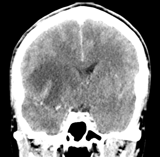 Cerebral abscess (Radiopaedia 60342-68008 Coronal C+ delayed 30).png