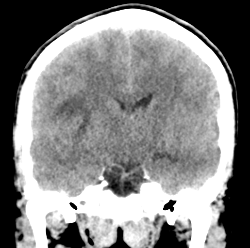 Cerebral abscess (Radiopaedia 60342-68008 Coronal non-contrast 32).png
