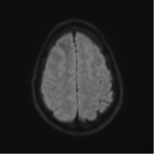 Cerebral abscess (Radiopaedia 60342-68009 Axial DWI 65).png