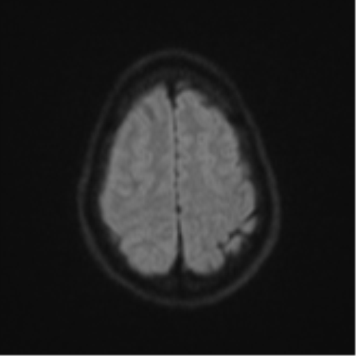 File:Cerebral abscess (Radiopaedia 60342-68009 Axial DWI 66).png