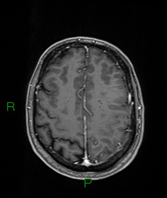 Cerebral abscess and subdural empyema (Radiopaedia 84436-99779 Axial T1 C+ 25).jpg