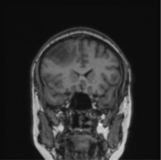 Cerebral abscess from pulmonary arteriovenous malformation (Radiopaedia 86275-102291 Coronal T1 62).png