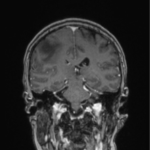 File:Cerebral abscess from pulmonary arteriovenous malformation (Radiopaedia 86275-102291 L 40).png