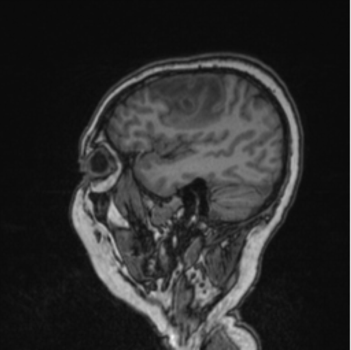 Cerebral abscess from pulmonary arteriovenous malformation (Radiopaedia 86275-102291 Sagittal T1 73).png