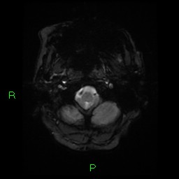 File:Cerebral amyloid angiopathy-associated lobar intracerebral hemorrhage (Radiopaedia 58376-65512 Axial Gradient Echo 24).jpg