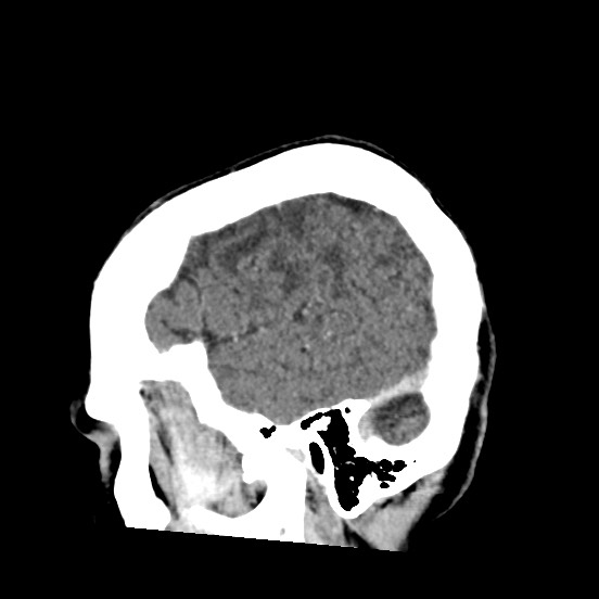 Cerebral amyloid angiopathy-related inflammation (Radiopaedia 74836-85848 C 11).jpg