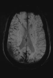 File:Cerebral amyloid angiopathy (Radiopaedia 29129-29518 Axial SWI MIP 20).jpg
