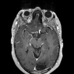 Cerebral amyloid angiopathy (Radiopaedia 29129-29518 Axial T1 C+ 64).jpg