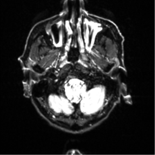 File:Cerebral amyloid angiopathy (Radiopaedia 46082-50433 Axial DWI 2).png