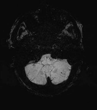 File:Cerebral amyloid angiopathy (Radiopaedia 46082-50433 Axial SWI MIP 11).png