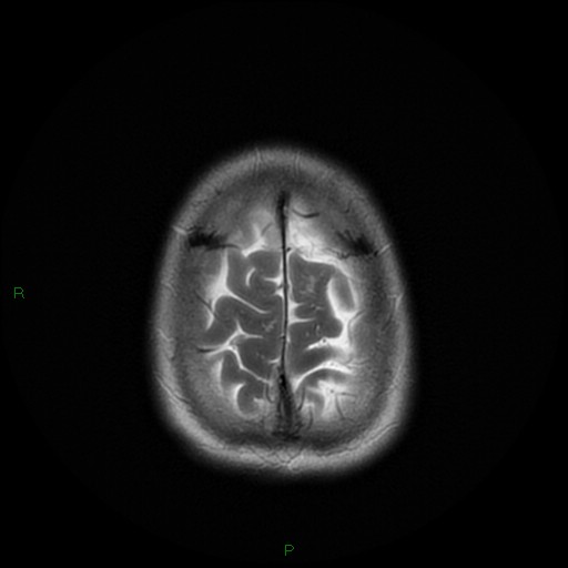 File:Cerebral amyloid angiopathy (Radiopaedia 77506-89664 Axial T2 26).jpg