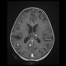 Cerebral and spinal tuberculosis (Radiopaedia 90489-107837 Axial T1 C+ 120).jpg