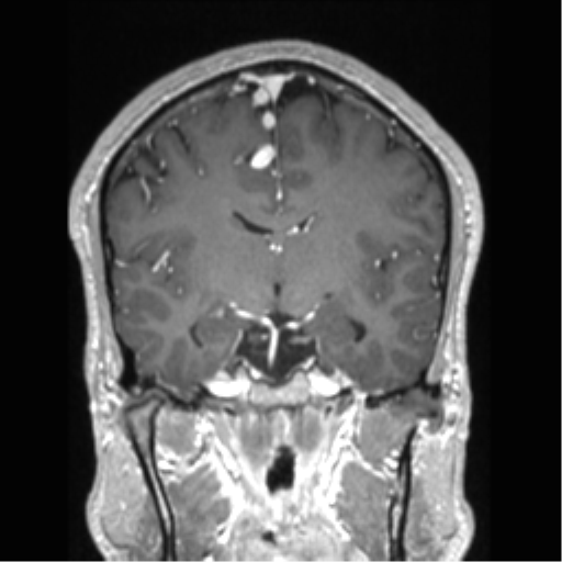 Cerebral arteriovenous malformation (Radiopaedia 39259-41506 Coronal T1 C+ 50).png