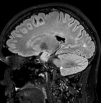 Cerebral arteriovenous malformation (Radiopaedia 74411-85746 Sagittal FLAIR 43).jpg