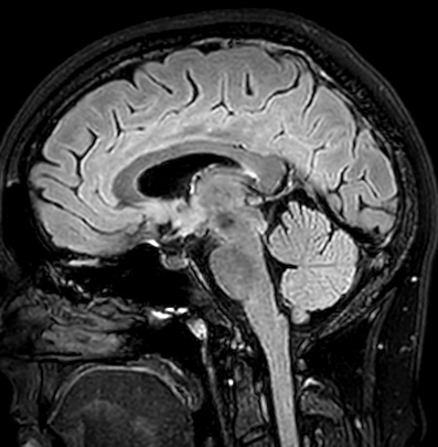 Cerebral arteriovenous malformation (Radiopaedia 74411-85746 Sagittal FLAIR 55).jpg