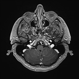 Cerebral arteriovenous malformation (Radiopaedia 84015-99245 Axial T1 C+ 36).jpg