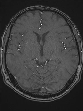 File:Cerebral arteriovenous malformation (Radiopaedia 84015-99245 Axial TOF 122).jpg