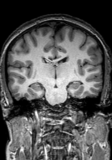 Cerebral arteriovenous malformation at posterior body of corpus callosum (Radiopaedia 74111-84925 Coronal T1 178).jpg