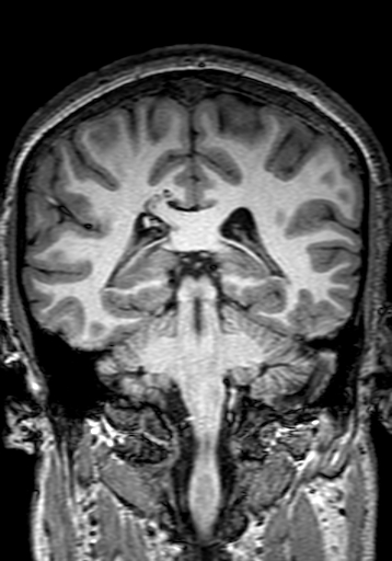 Cerebral arteriovenous malformation at posterior body of corpus callosum (Radiopaedia 74111-84925 Coronal T1 215).jpg