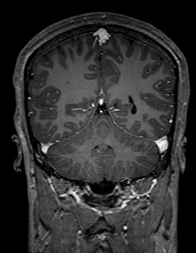 Cerebral arteriovenous malformation at posterior body of corpus callosum (Radiopaedia 74111-84925 K 265).jpg