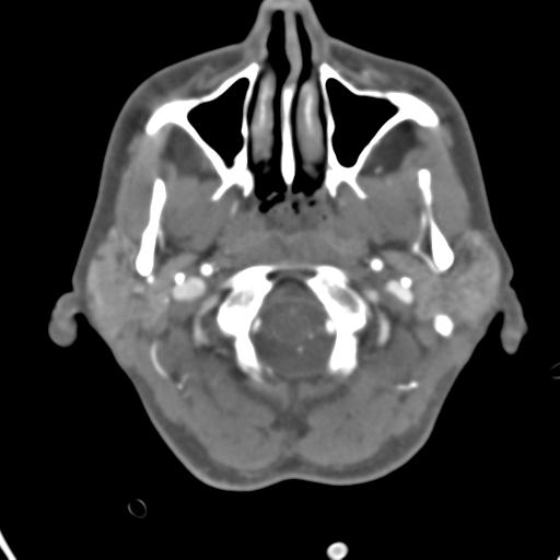 Cerebral arteriovenous malformation with hemorrhage (Radiopaedia 28773-29073 A 50).jpg