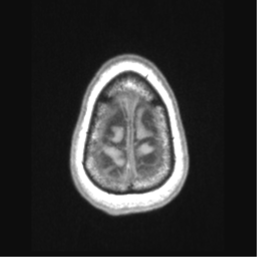 Cerebral arteriovenous malformation with hemorrhage (Radiopaedia 34422-35737 Axial T1 71).png