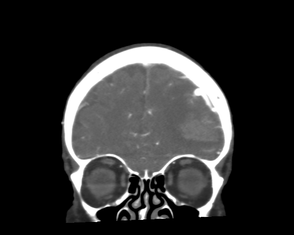 File:Cerebral arteriovenous malformation with lobar hemorrhage (Radiopaedia 44725-48511 A 13).png