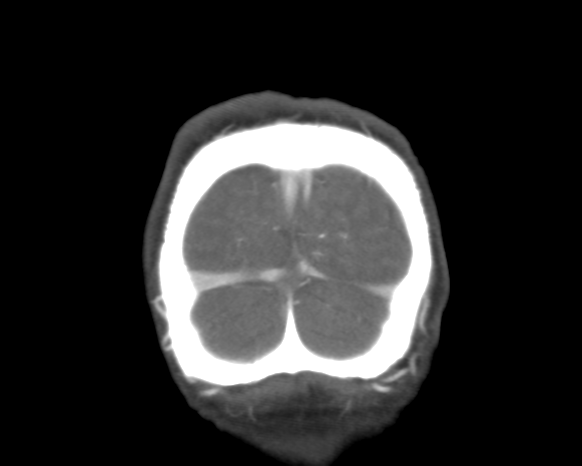Cerebral arteriovenous malformation with lobar hemorrhage (Radiopaedia 44725-48511 A 53).png