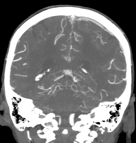 File:Cerebral arteriovenous malformation with lobar hemorrhage (Radiopaedia 44725-48511 B 38).png