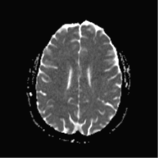 File:Cerebral cavernoma and development venous anomaly (Radiopaedia 37603-39482 Axial ADC 15).png