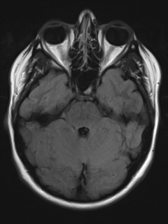 File:Cerebral cavernoma and development venous anomaly (Radiopaedia 37603-39482 Axial FLAIR 7).png