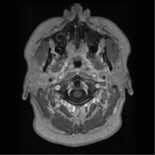 Cerebral cavernoma and development venous anomaly (Radiopaedia 37603-39482 Axial T1 C+ 3).png