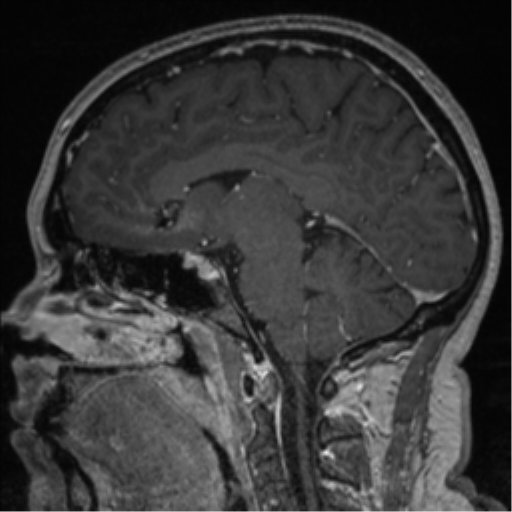 Cerebral cavernoma and development venous anomaly (Radiopaedia 37603-39482 Sagittal T1 C+ 45).png