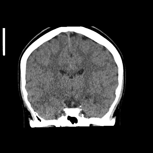 Cerebral cavernous venous malformation (Radiopaedia 70008-80022 non-contrast 37).jpg