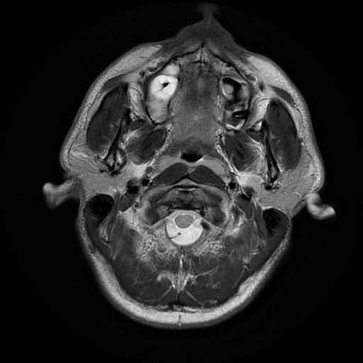 File:Cerebral cavernous venous malformation (Zabramski type II) (Radiopaedia 85511-101198 Axial T2 2).jpg